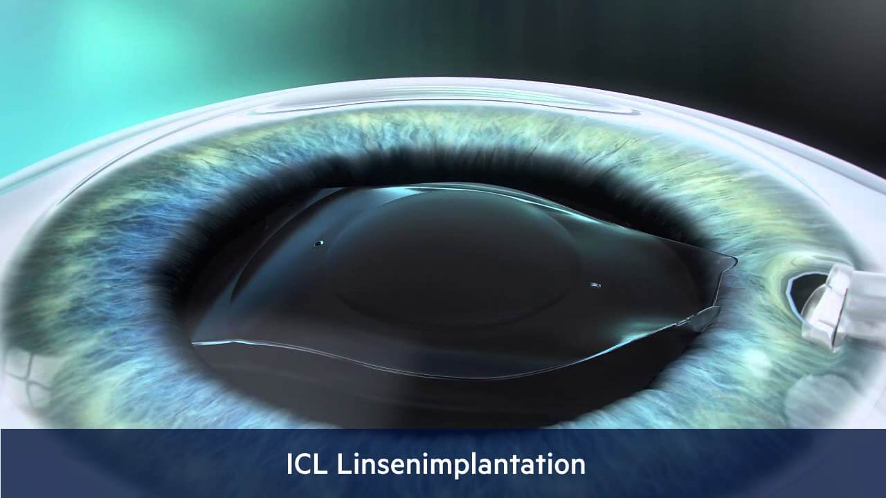 ICL, Augenärzte Linz, Dirisamer Luft Priglinger