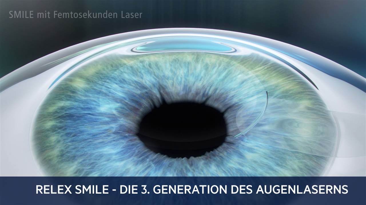 ReLEx Smile, Augenärzte Linz, Dirisamer Luft Priglinger